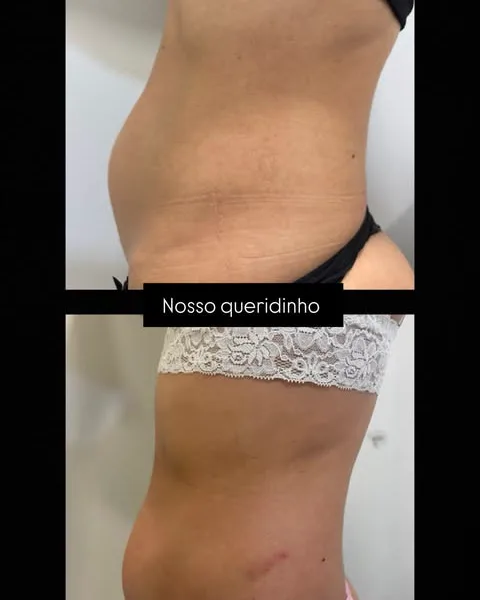 Post com antes e depois do abdômen: nosso queridinho