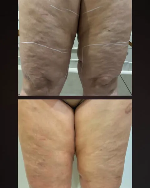 Post com antes e depois das coxas